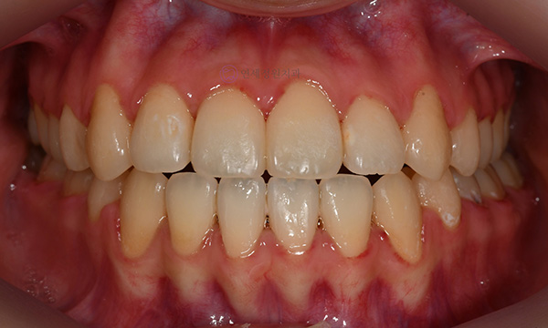 치아 중심선이 안 맞아요! 치아 비대칭 교정으로 가능할까요? @ 대치동 교정치과 연세정원치과 관련 이미지 13