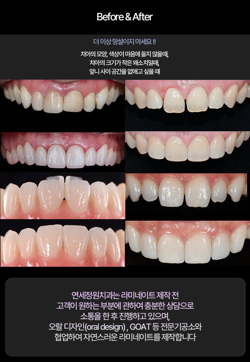 대치동 무삭제, 최소삭제 라미네이트 비용 관련 이미지 5