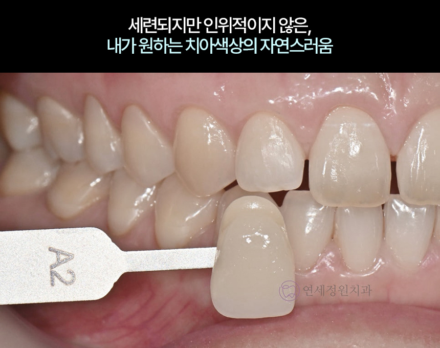 대치동 무삭제, 최소삭제 라미네이트 비용 관련 이미지 4