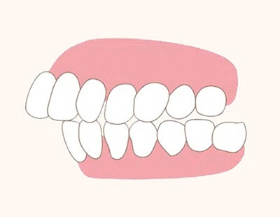 My Child Has a Receding Chin—Is It Simply Hereditary? Why It Shouldn’t Be Left Untreated image 2