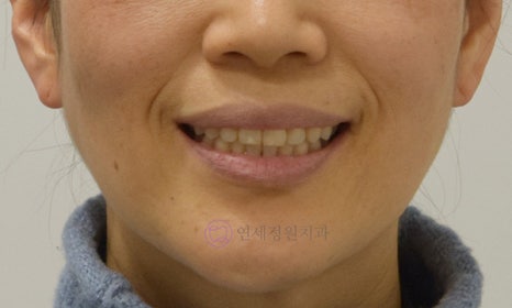 중년의 치아교정 시 고려할 사항, 대치동 연세정원치과 관련 이미지 5