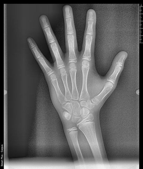 아이들이 더 좋아하는 인비절라인 퍼스트 @ 대치동 교정치과 연세정원치과 관련 이미지 6