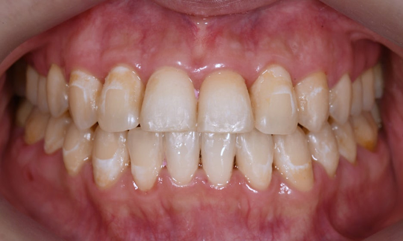 ICON Resin Treatment: White Spots on Front Teeth - Are They Cavities? 관련 이미지 3