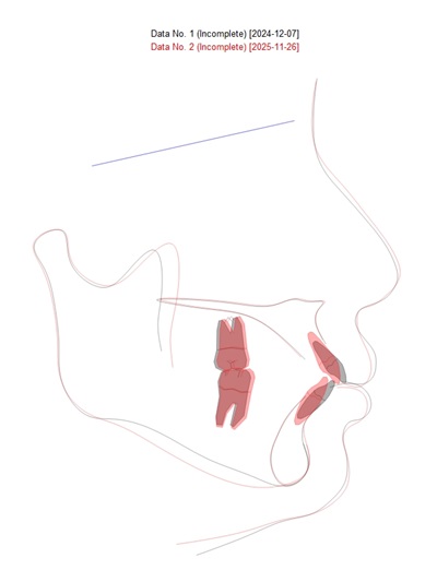 Smile makeover: 인비절라인 라이트와 앞니 심미보철 관련 이미지 4