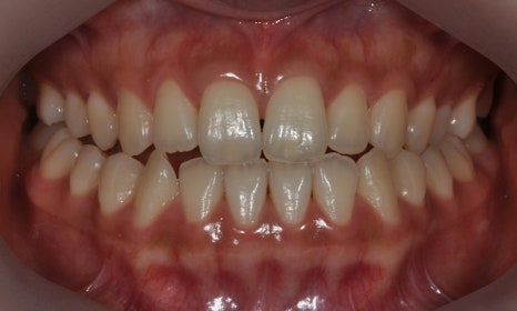 악궁확장장치(RPE, MARPE, MSE) 돌리는 방법 관련 이미지 3