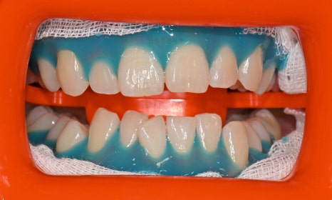 원데이 치아미백의 순서 @ 대치동 치아미백 연세정원치과의원 관련 이미지 11