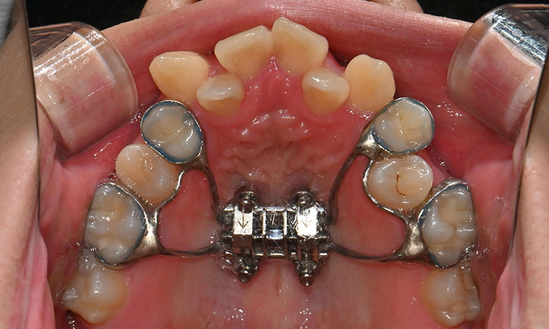 악궁확장장치(RPE, MARPE, MSE) 돌리는 방법 관련 이미지 7