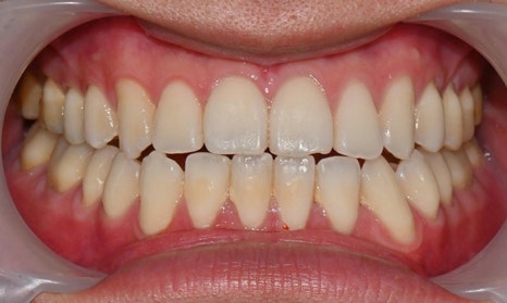 Teeth Whitening After Orthodontic Treatment at Yonsei JW Dental Clinic image 2