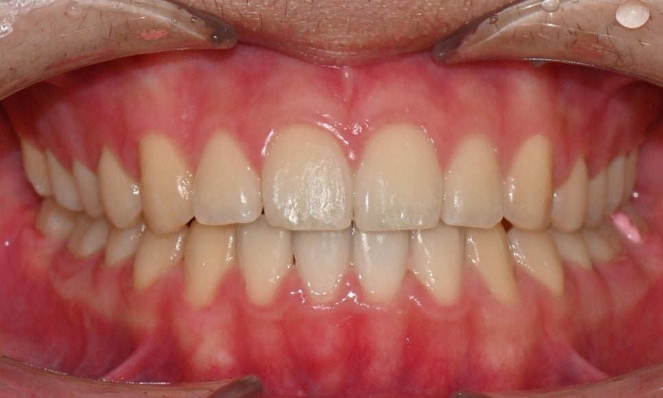 치아 중심선 비대칭과 아랫입술 돌출 개선 관련 이미지 18