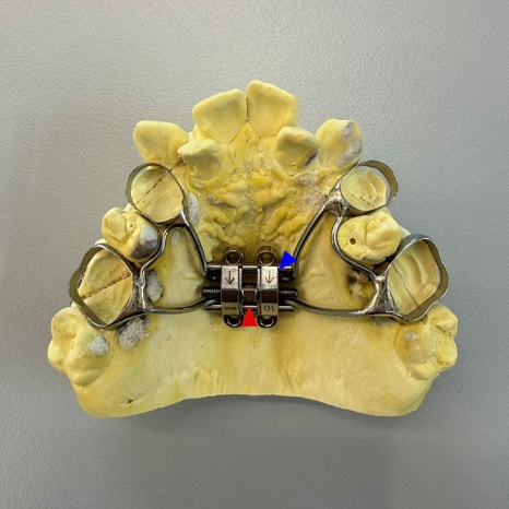 악궁확장장치(RPE, MARPE, MSE) 돌리는 방법 관련 이미지 9