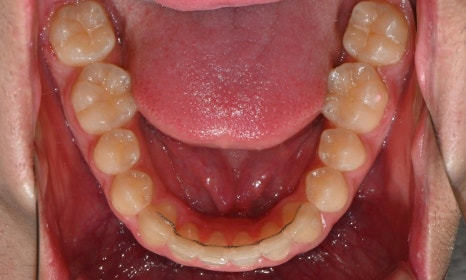 치아 중심선 비대칭과 아랫입술 돌출 개선 관련 이미지 22