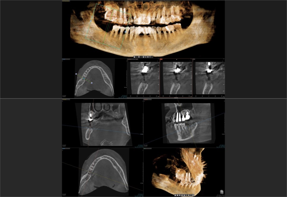 임플란트 1차 수술 vs 2차 수술 관련 이미지 3