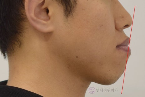 주걱턱 치아 교정만으로 치료 가능할까요? @ 대치동 교정치과 연세정원치과 관련 이미지 6