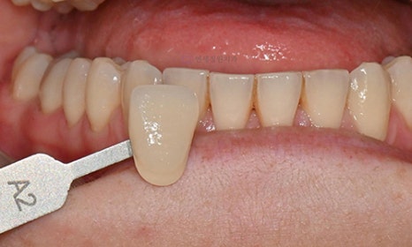 Teeth Whitening Case : A couple from the Netherlands 관련 이미지 10
