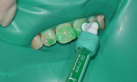 앞니 치아 하얀 점, 충치인가요? (화이트 스팟, 반점치) 아이콘 레진 치료의 순서 관련 이미지 6