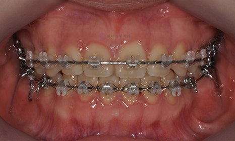 어금니가 겹쳐서 났어요! 이소맹출 소구치 치아교정, 대치동 교정치과 관련 이미지 5