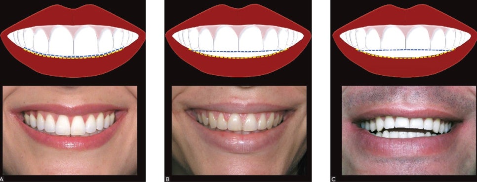 Smile makeover: 인비절라인 라이트와 앞니 심미보철 관련 이미지 3