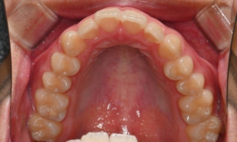 치아 중심선 비대칭과 아랫입술 돌출 개선 관련 이미지 6