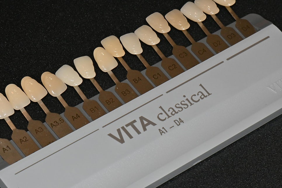 Precautions for Teeth Whitening Treatment @ Yonsei JW Dental Clinic 관련 이미지 4