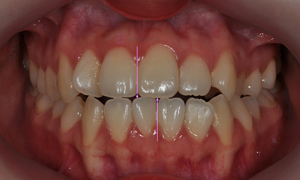 치아 중심선이 안 맞아요! 치아 비대칭 교정으로 가능할까요? @ 대치동 교정치과 연세정원치과 관련 이미지 8
