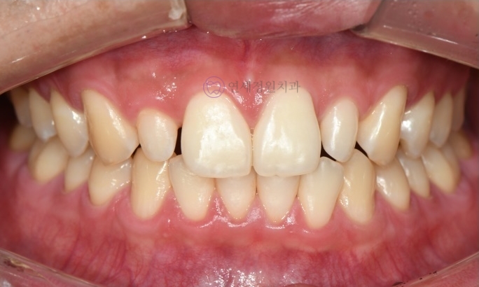 레진 비니어 등의 레진 치료를 이용한 앞니 형태 개선 (왜소치, diastema, black triangle) @ 대치동 연세정원치과 관련 이미지 2