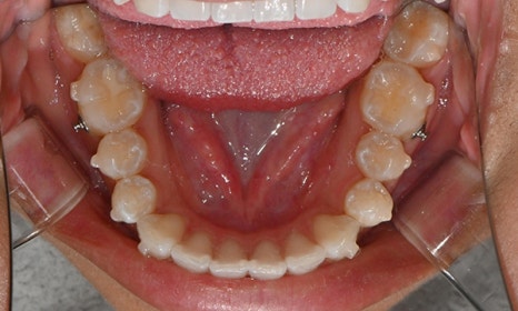 인비절라인 앞니 사이 공간 및 덧니 교정 관련 이미지 11