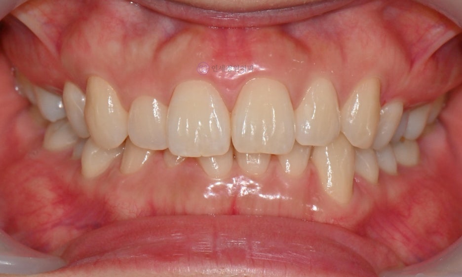 One Day Teeth Whitening Process @ Yonsei JW Dental Clinic 관련 이미지 19