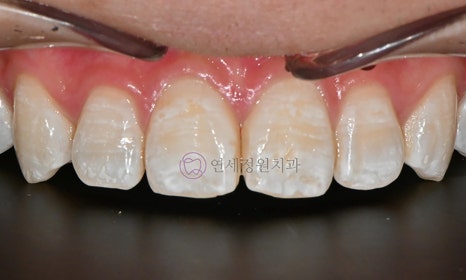 치아 미백 후 반점치의 아이콘 레진 치료 @ 대치동 연세정원치과 관련 이미지 3