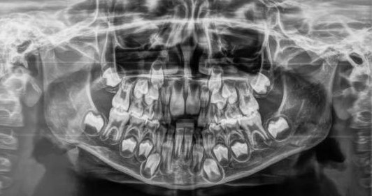 유치 안쪽에서 치아가 올라와요! (대치동 소아치과 연세정원치과) 관련 이미지 2