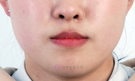 비수술 주걱턱 교정, 대치동 교정치과 연세정원치과 관련 이미지 3