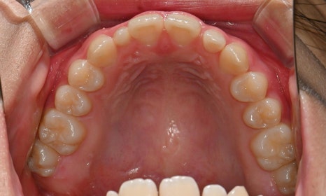 왜소치 치료 - 라미네이트 vs 레진비니어 vs 치아교정 관련 이미지 22