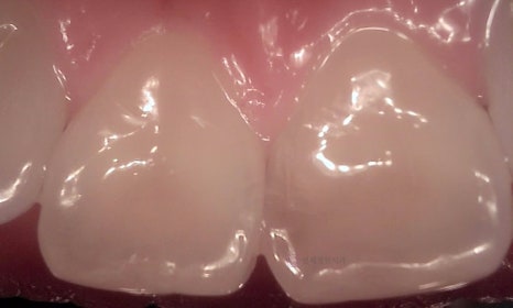 앞니 심미 레진 치료 : 블랙트라이앵글, 앞니 사이 공간 @ 대치동 연세정원치과 관련 이미지 12