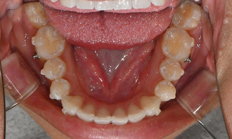 개포동 앞니 사이 공간 및 덧니 교정을 원한다면 관련 이미지 11