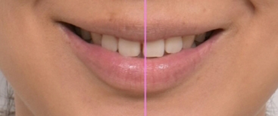 앞니 벌어짐 부분교정 (재교정) 관련 이미지 9