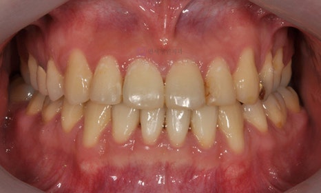 비대칭 및 돌출입 치아교정, 대치동 교정치과 연세정원치과 관련 이미지 7