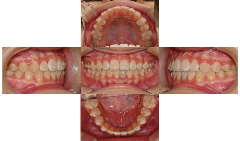 Why Is a Second Phase of Orthodontic Treatment Needed After the First? – A Case of Invisalign Treatment for a Growing Patient with Anterior Crossbite image 8