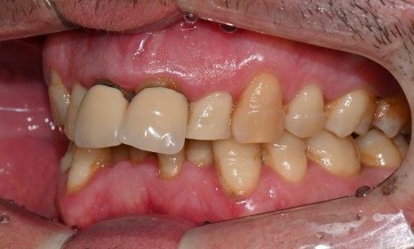 과개교합과 손상된 앞니, 심미와 기능을 함께 회복한 앞니 심미보철 케이스 관련 이미지 5