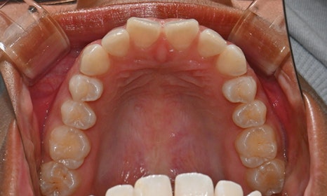 인비절라인 앞니 사이 공간 및 덧니 교정 관련 이미지 5