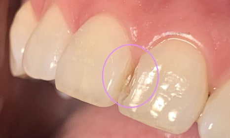 앞니 심미 레진 치료 : 블랙트라이앵글, 앞니 사이 공간 @ 대치동 연세정원치과 관련 이미지 9