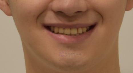 비대칭 및 돌출입 치아교정, 대치동 교정치과 연세정원치과 관련 이미지 11