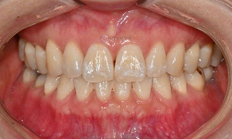 White Spot on My Front Tooth: Cavity or White Spot Lesion? 관련 이미지 3