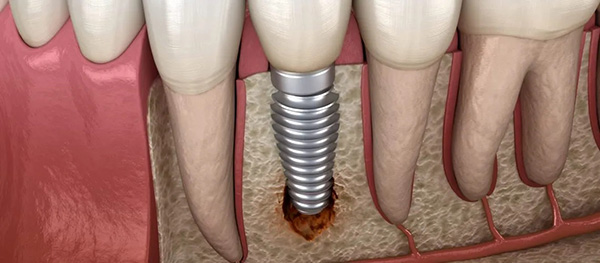 임플란트 주위염의 치료 및 예방법, 대치동치과 관련 이미지 2