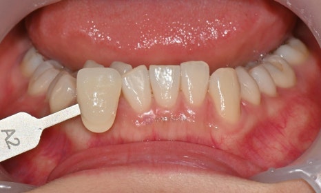 원데이 치아미백의 순서 @ 대치동 치아미백 연세정원치과의원 관련 이미지 9