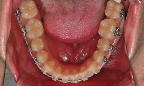 치아 중심선 비대칭과 아랫입술 돌출 개선 관련 이미지 17