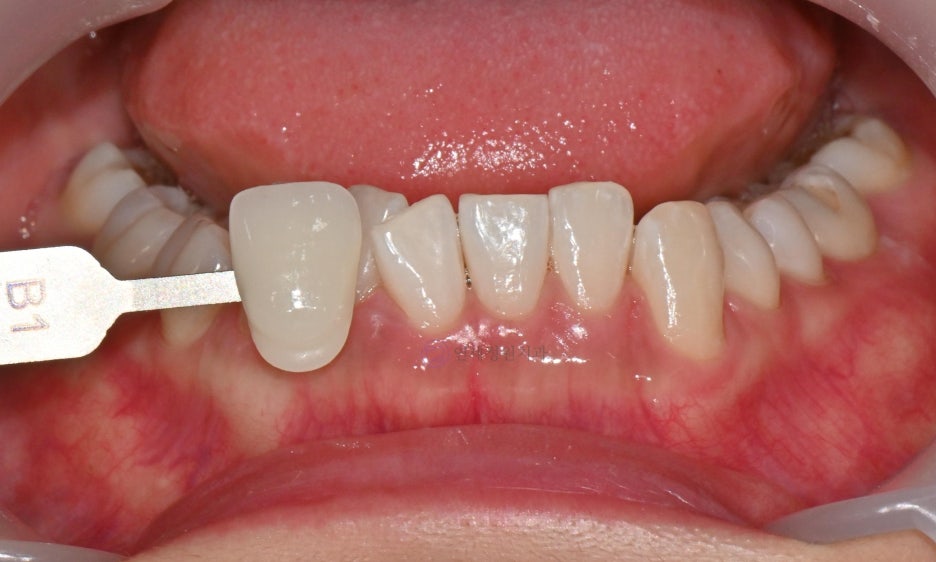 One Day Teeth Whitening Process @ Yonsei JW Dental Clinic 관련 이미지 17