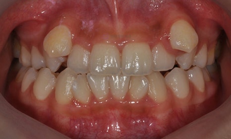 어금니가 겹쳐서 났어요! 이소맹출 소구치 치아교정, 대치동 교정치과 관련 이미지 2