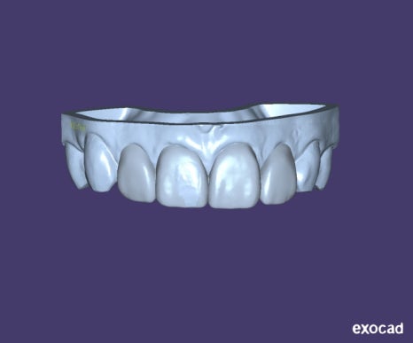 무삭제 라미네이트 vs 인비절라인 익스프레스 관련 이미지 6