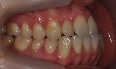 비대칭 및 돌출입 치아교정, 대치동 교정치과 연세정원치과 관련 이미지 14