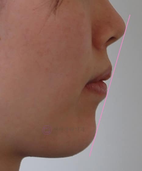 앞니가 안 물려요! 개방교합(openbite) 치아교정 전후 및 후기 관련 이미지 14