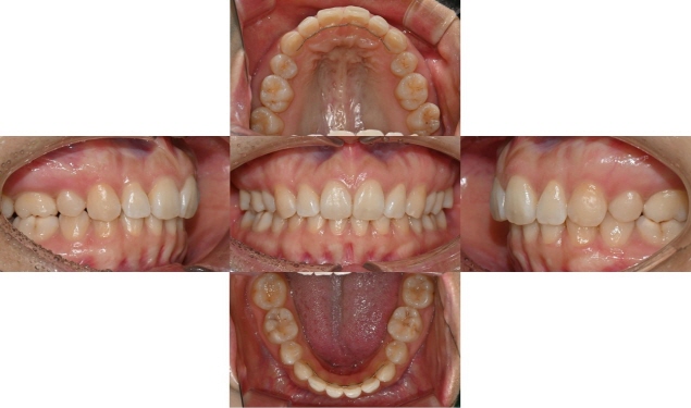 인비절라인 익스프레스 부분교정 <앞니 재교정> 관련 이미지 8